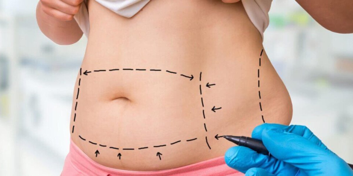 Benefits of Mini Tummy Tuck Dubai for Mild Skin Laxity