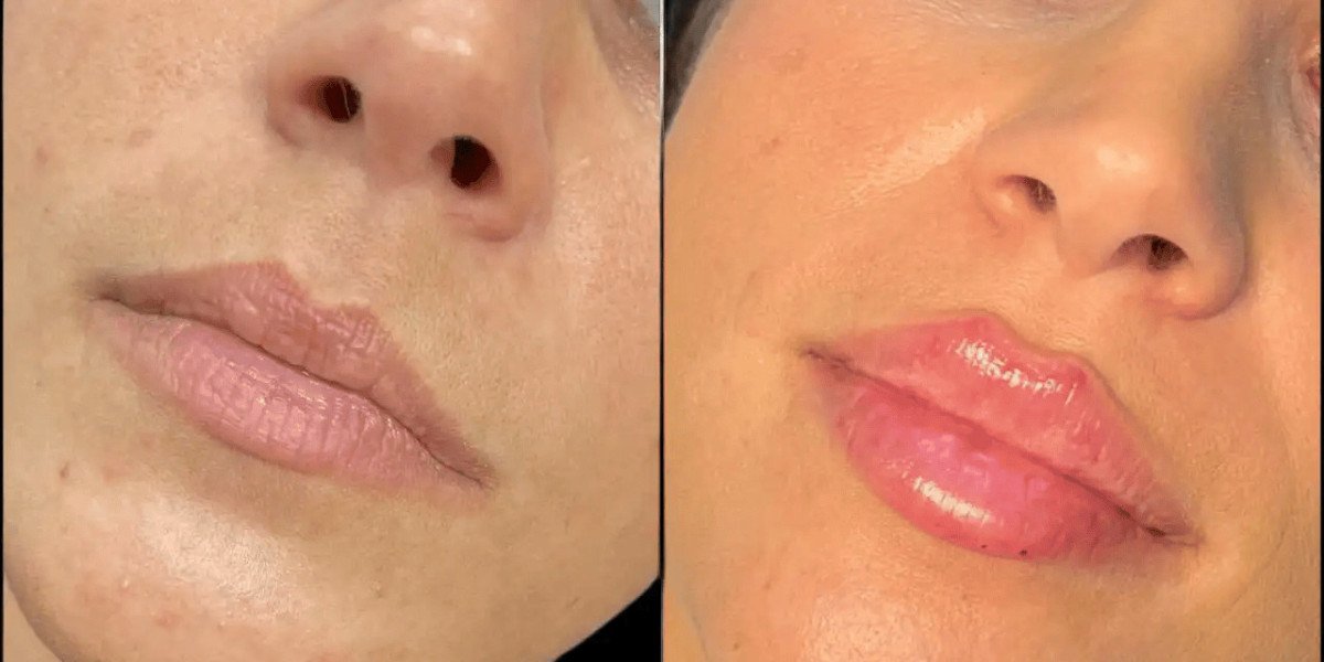 Best Aesthetic Clinics in Dubai for Russian Lip Fillers Personalized Treatments